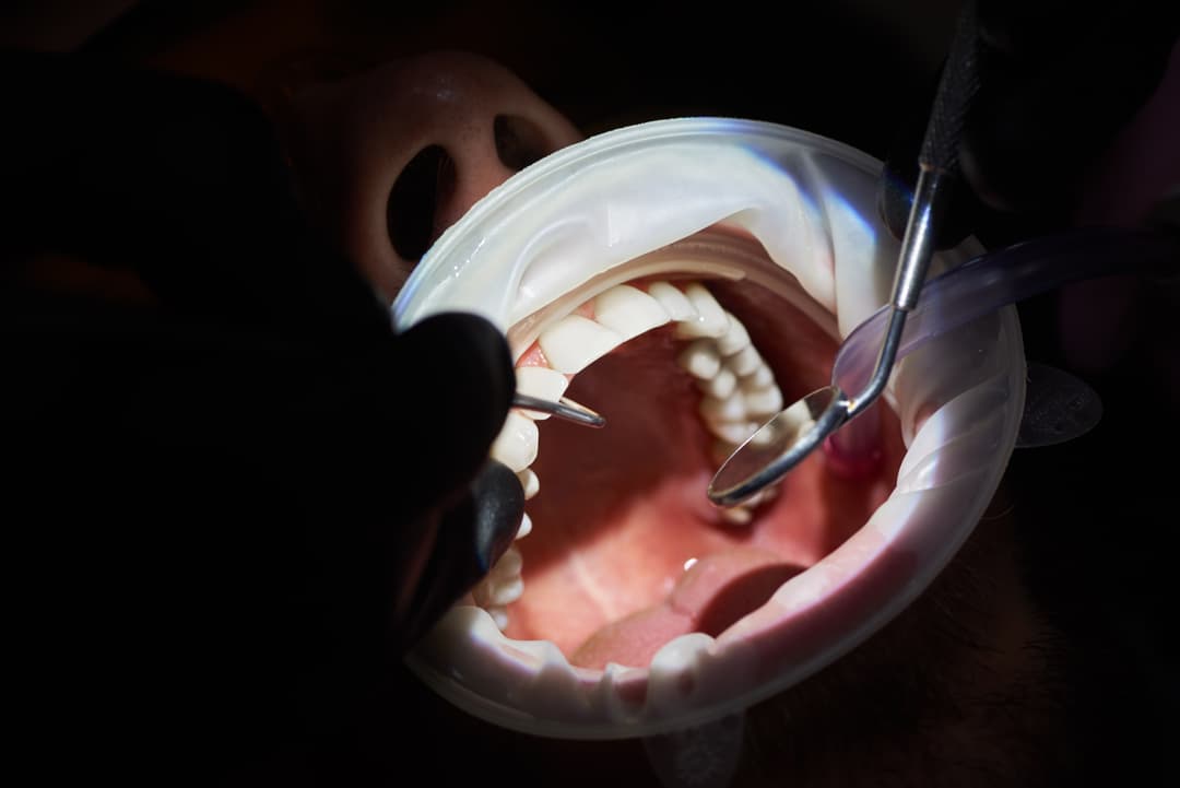 Dr. Udey Wirring — Crowns & Bridges